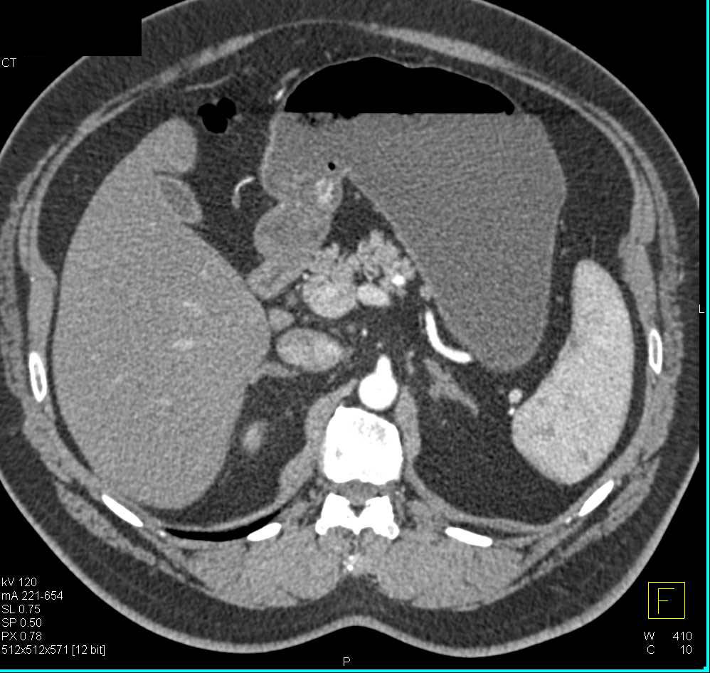 Ulcer with Active Bleed in Gastric Antrum - CTisus CT Scan