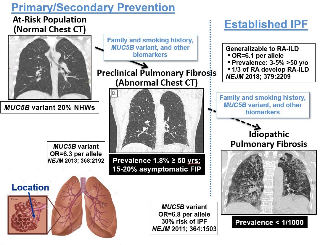 Pulmonary Fibrosis Stages