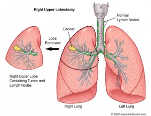 Role of surgery in lung infection