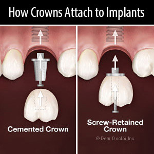 Cemented or Screwed: Which Implant Crown Attachment is Best for You?