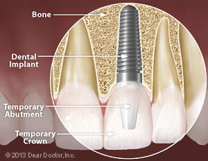 Same-Day Tooth Replacement With Dental Implants