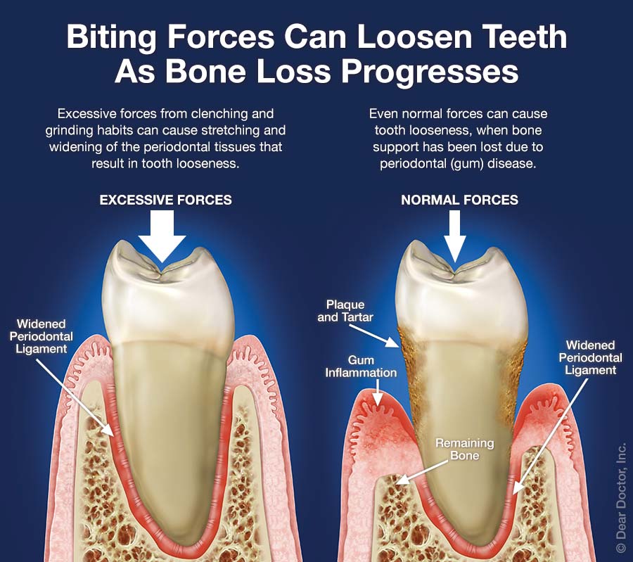 Causes Of A Loose Tooth