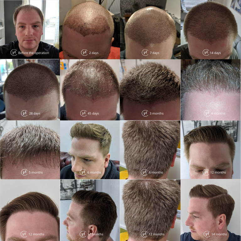 Hair Restoration Recovery