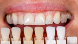 How much do veneers cost for teeth?