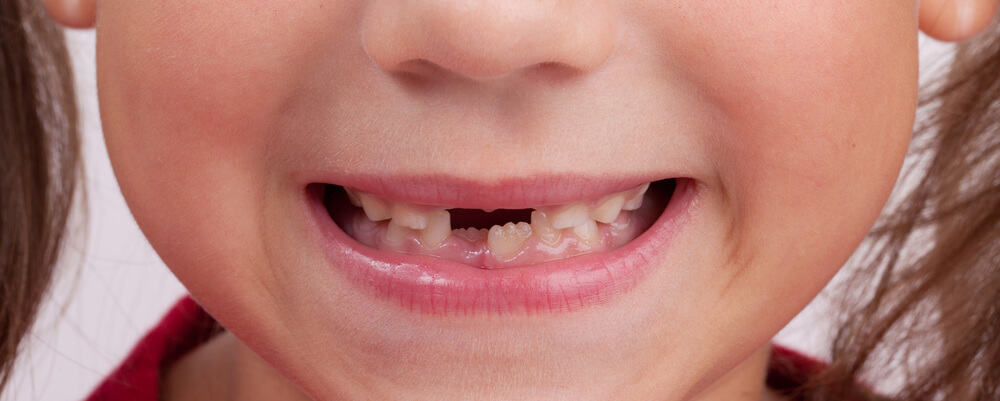 A child with several missing milk teeth