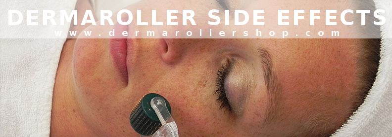 Worried about derma roller side effects? Find out what to expect after derma rolling and if there are any derma roller side effects you should know.