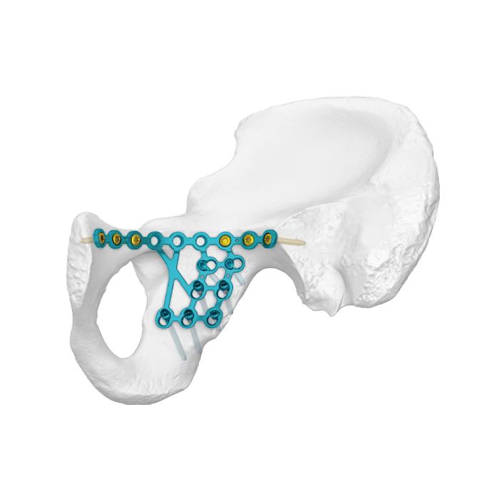 Low Posterior Column Infra-arcuate Line Locking Plate