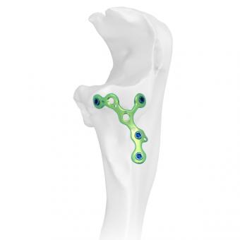 Elbow Plating System Coronoid Plate