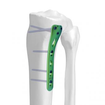 AxSOS 3 Ti Proximal Tibia Plating System