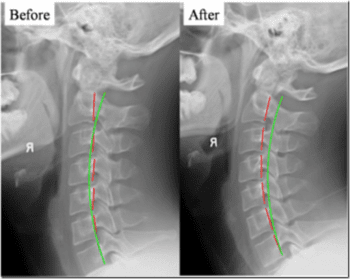 Whiplash Specialist: Identifying Loss of Cervical Curvature - El Paso ...