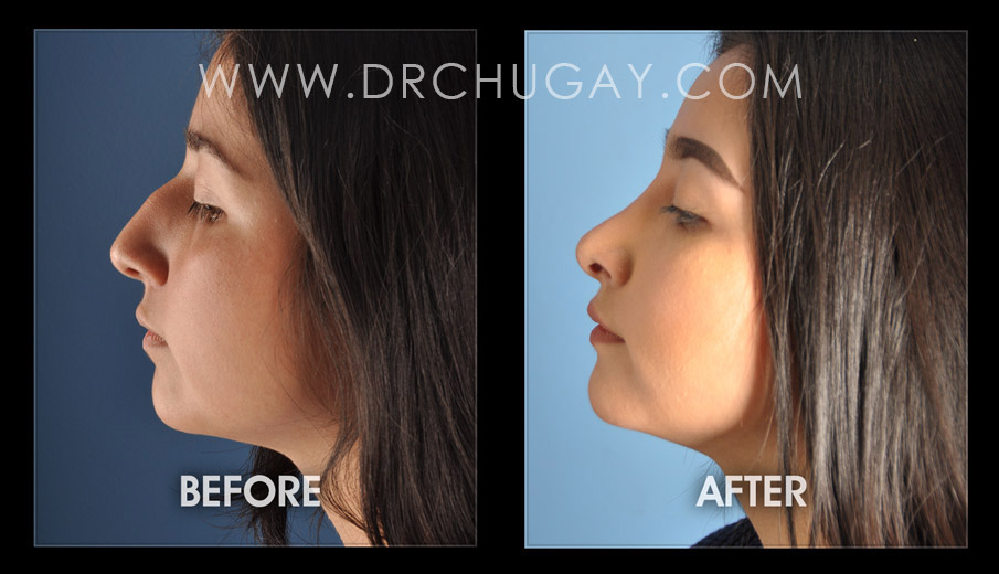 Rhinoplasty - Plastic Surgery, Nose Job, Huntington Beach, CA