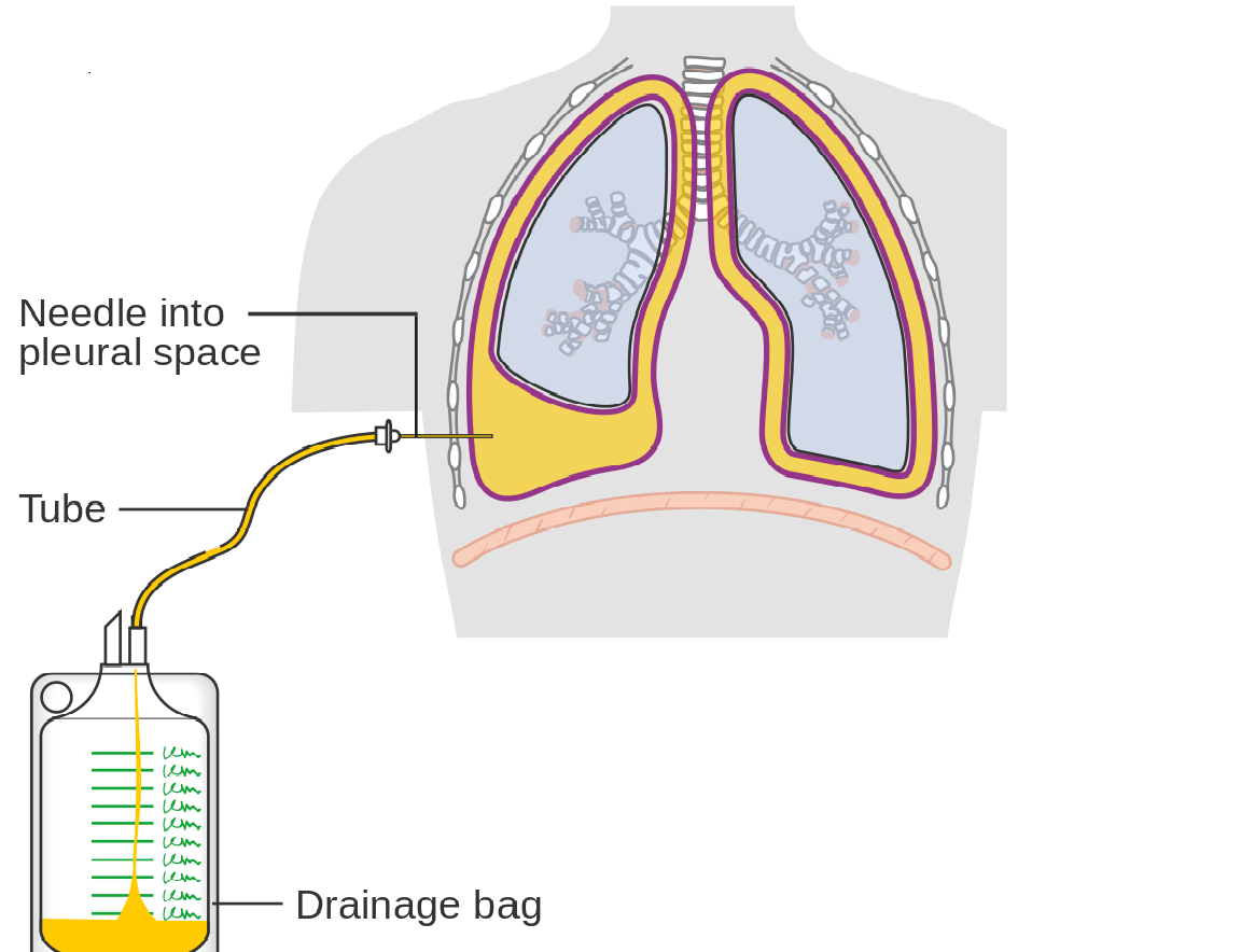 Learn About Pleural Effusion Drainage Drainage Of A Pleural Effusion ...