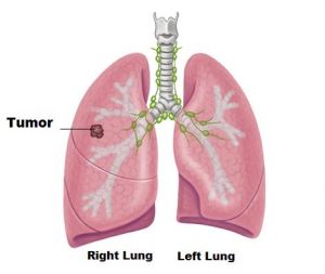 lung-tumor image - drkelleyenzymes.com