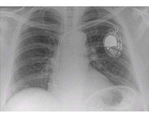 Implantation takes longer than conventional pacemaker procedures - 2 or ...