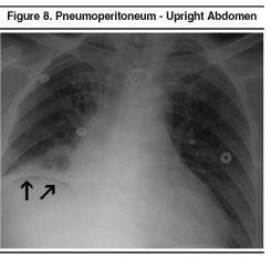 Intestinal Perforation