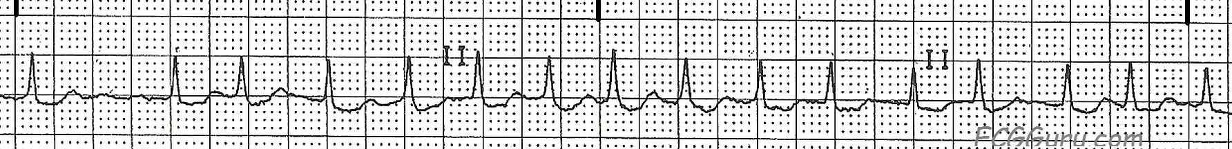 Atrial Fibrillation With Rapid Ventricular Response - vrogue.co