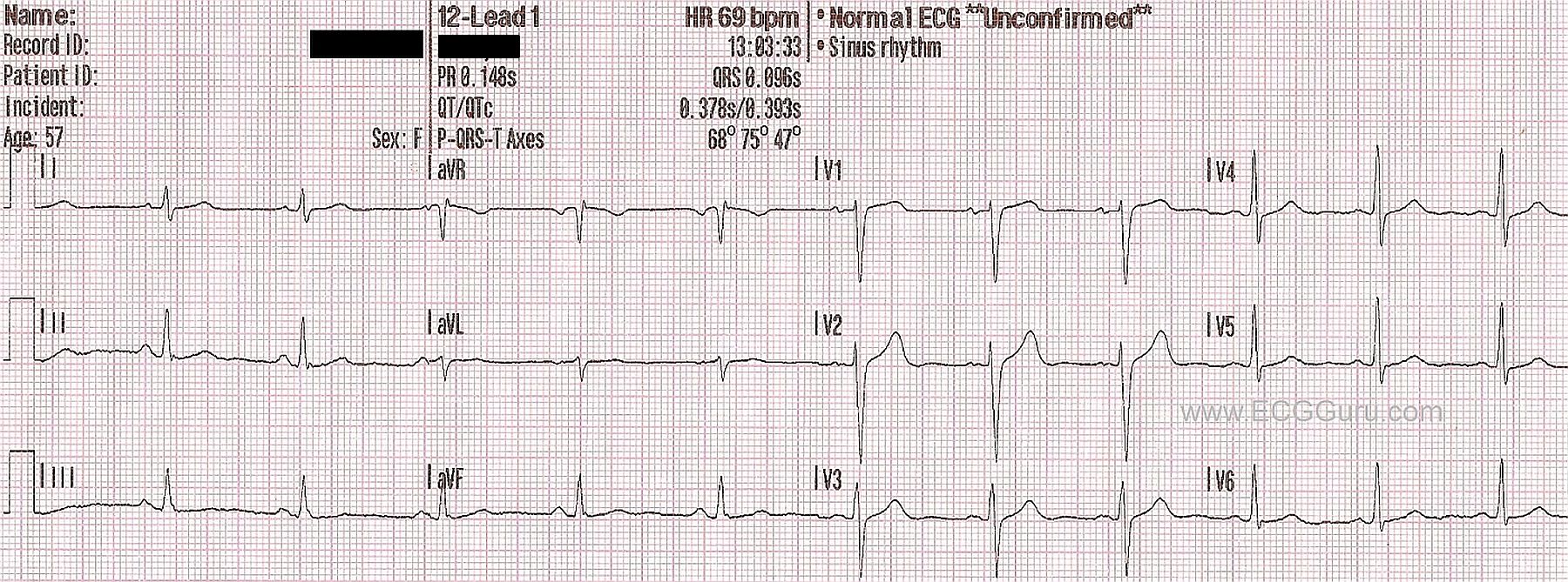 Normal Ecg