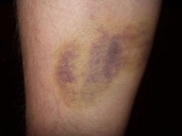 Hematoma1.JPG