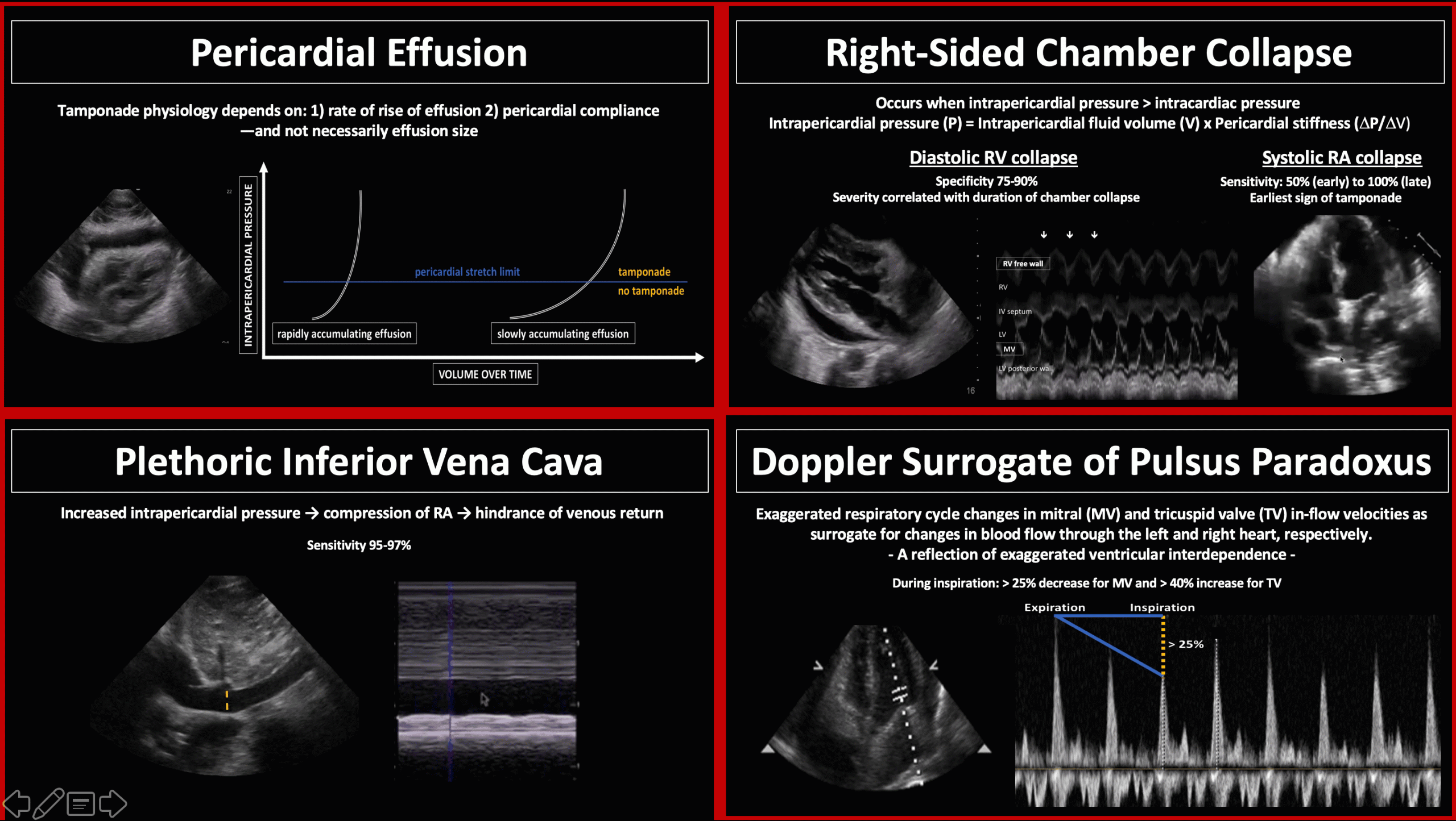 Pericardial Tamponade Ultrasound