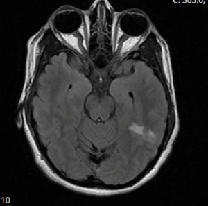 Preeclampsia Complicated by a Cerebrovascular Accident, Posterior ...