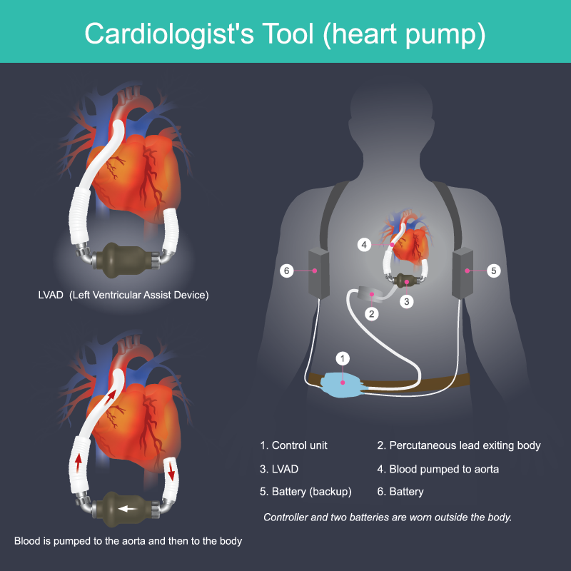 LVAD - Fig 1 - web.png