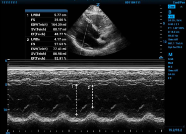 ccus - fractional shortening fig 1.png