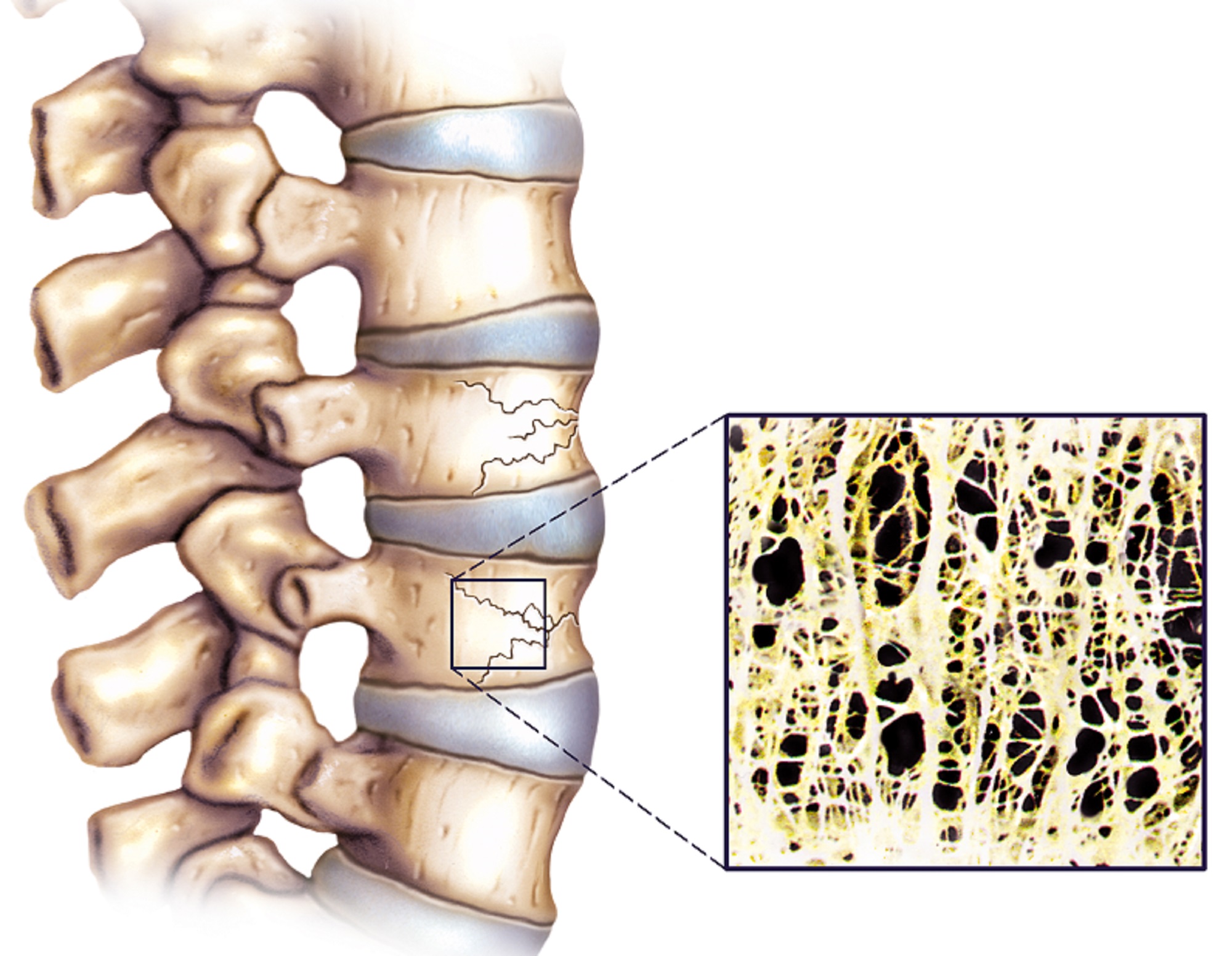 Osteoporotic Vertebral Compression Fracture Image