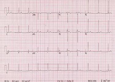 Arrhythmogenic Right Ventricular Dysplasia