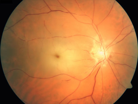 Retina Louisville | Retinal Artery Occlusion KY | Bennett & Bloom