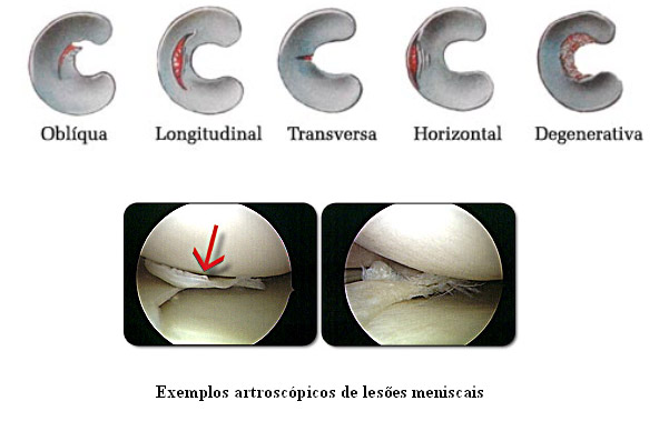 lesão de menisco dr emerson zanoni