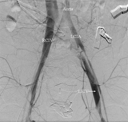 A Rare Case of Traumatic Bilateral Femoral Arteriovenous Fistulas with ...