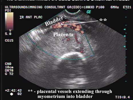 Lacunae Placenta