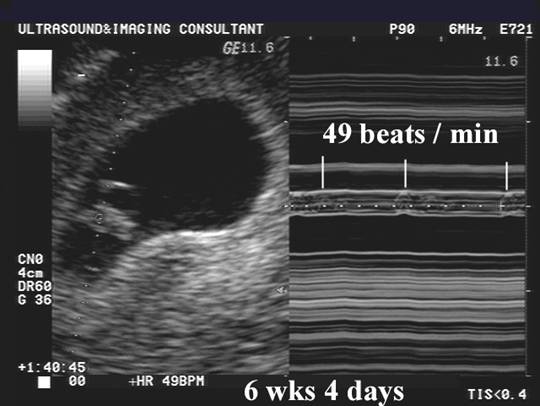 Fetal Heart Rate Ultrasound Images : Unfortunately, an abnormal fetal ...