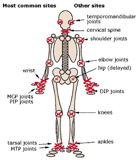 Rheumatoid Arthritis Treatment Guidelines - Fever.pk