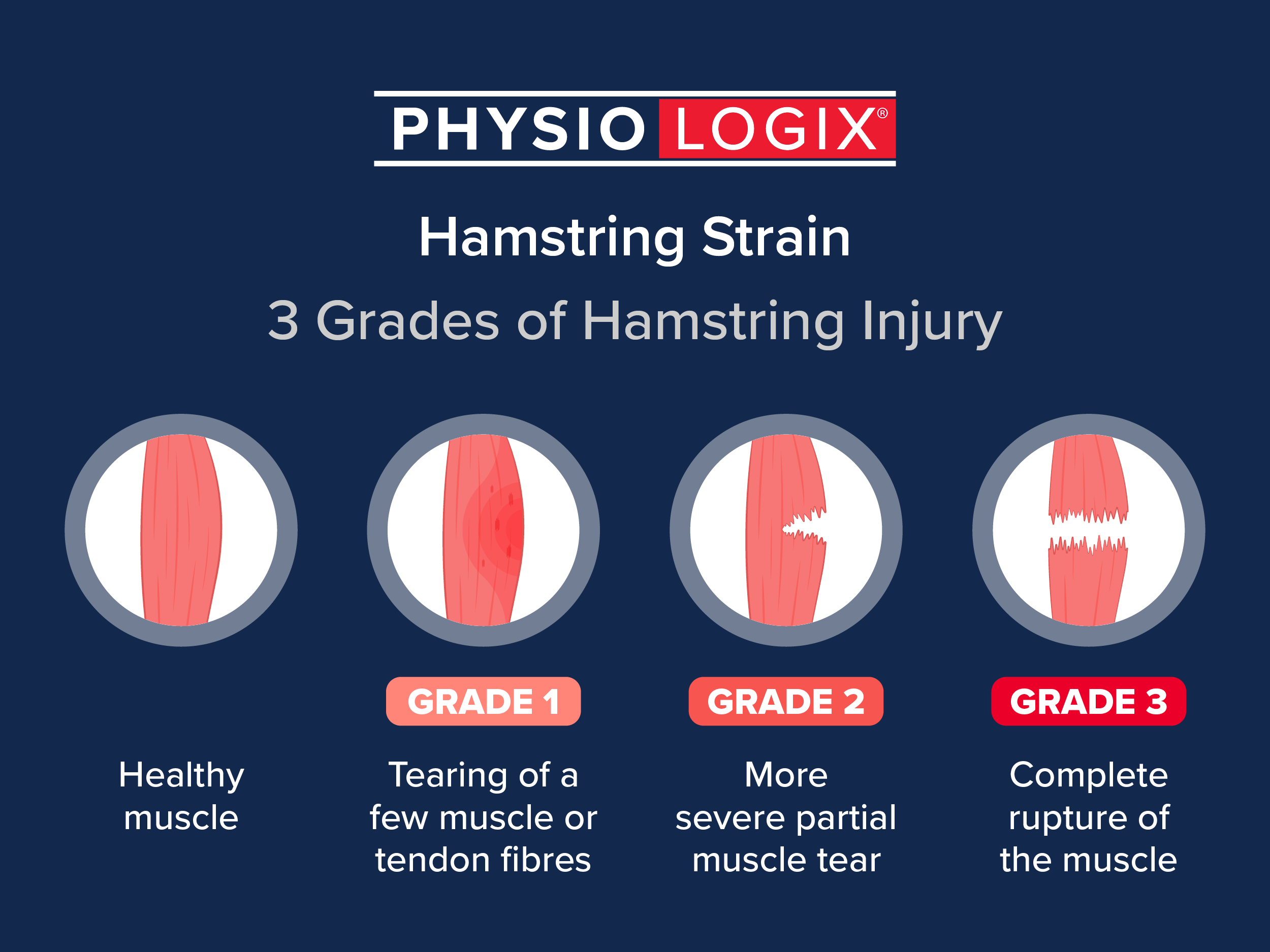 Different Grades of Hamstring Tears