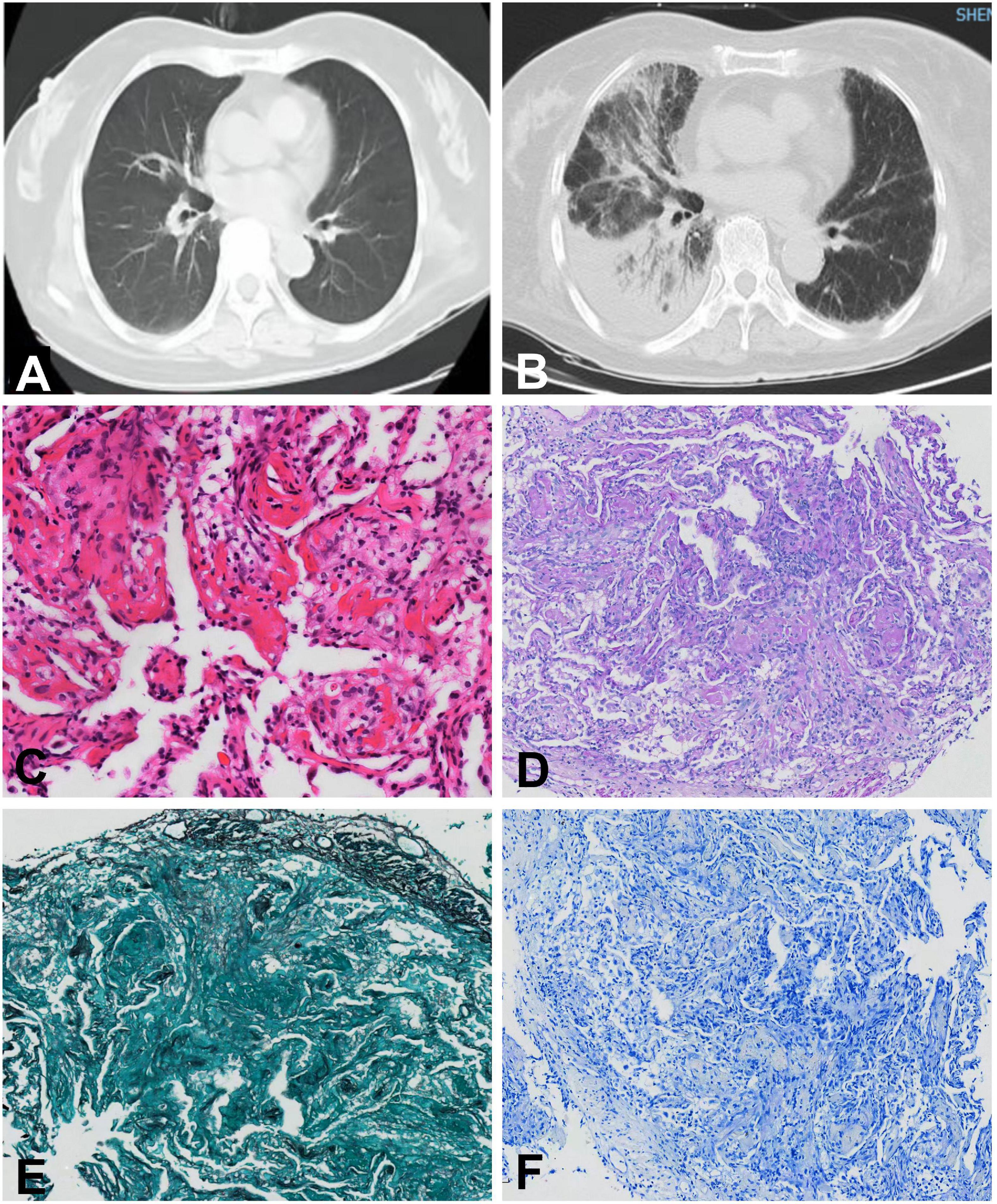 Frontiers | Multisystem immune-related adverse events due to ...