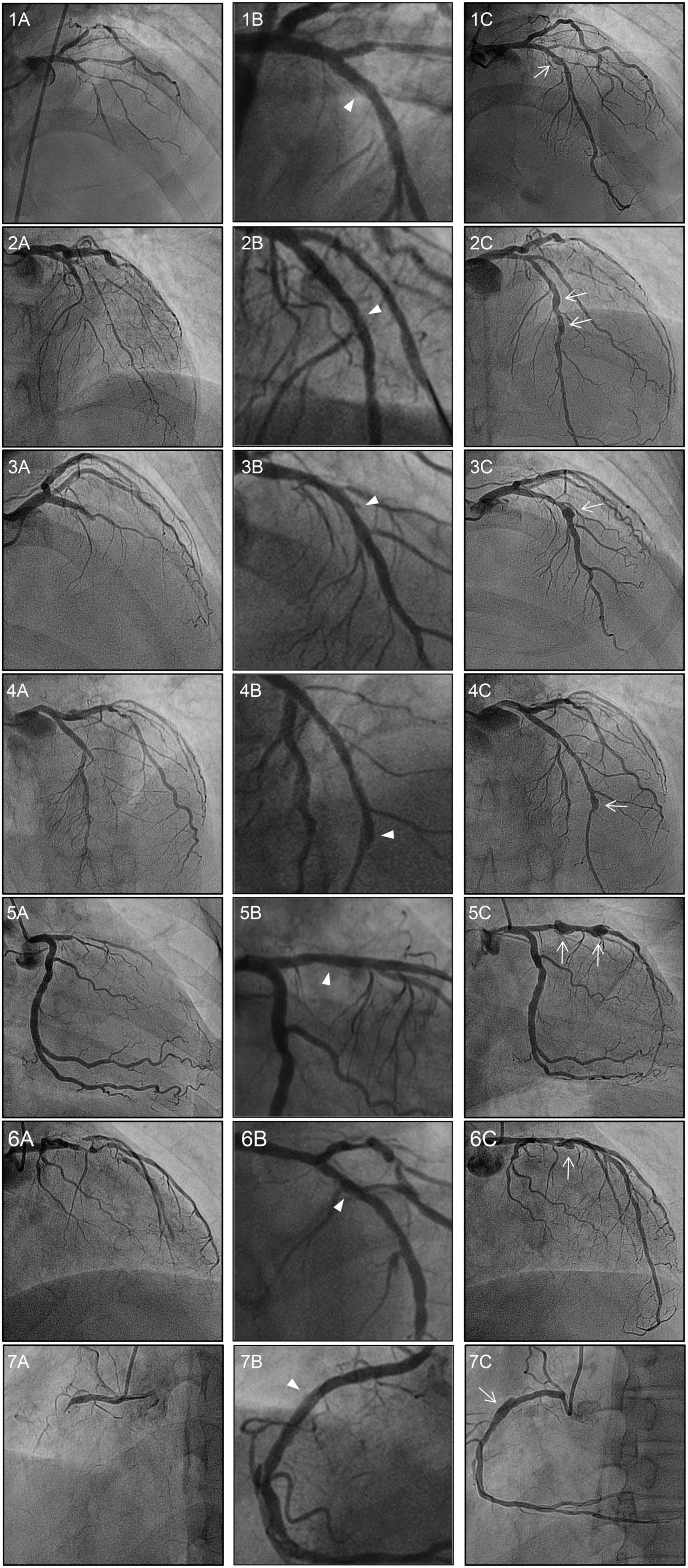 Frontiers | Coronary artery aneurysm formation after paclitaxel-coated ...