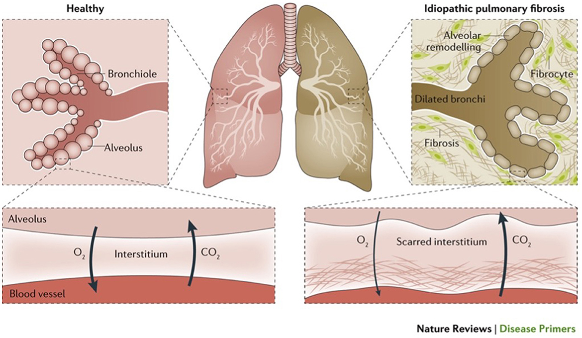 Frontiers | Interstitial lung disease: a review of classification ...