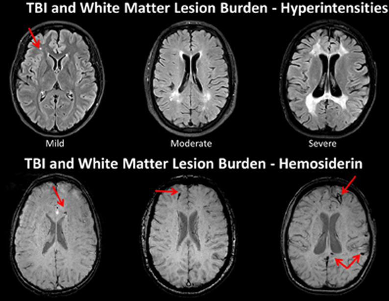 Traumatic Brain Injury Mri