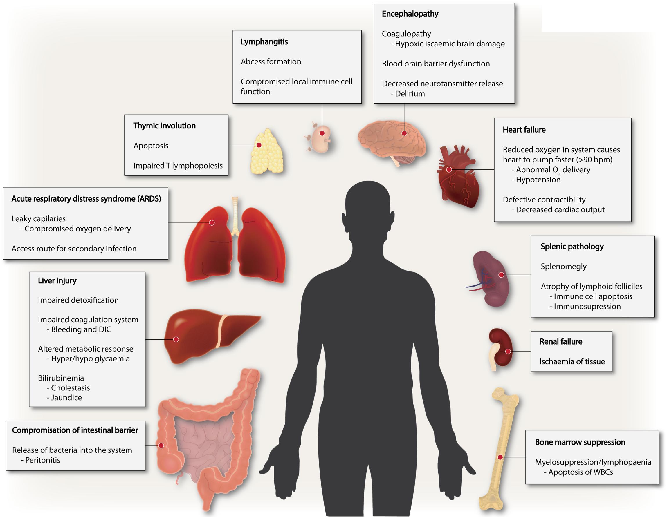 What Is Sepsis Syndrome - vrogue.co