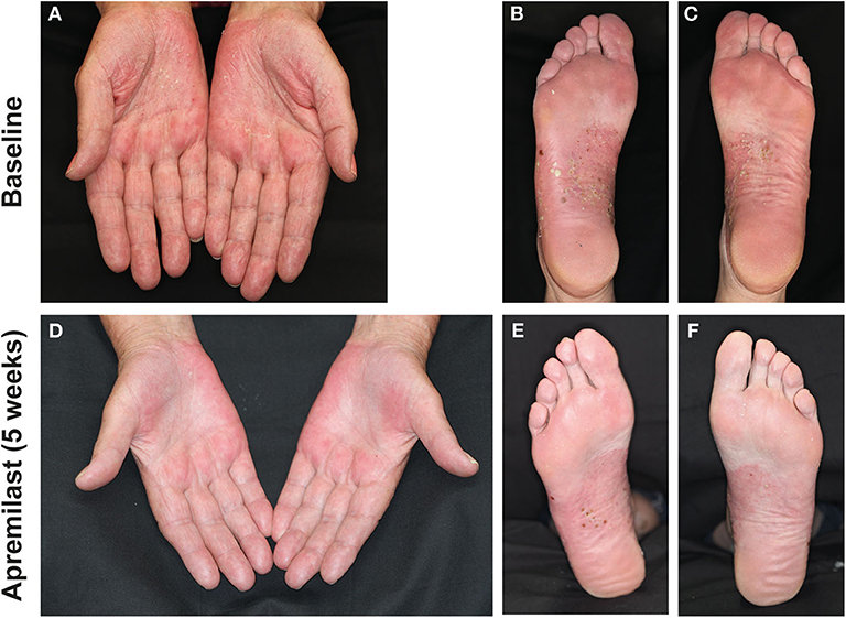 Frontiers | Successful Treatment of Refractory Palmoplantar Pustular ...