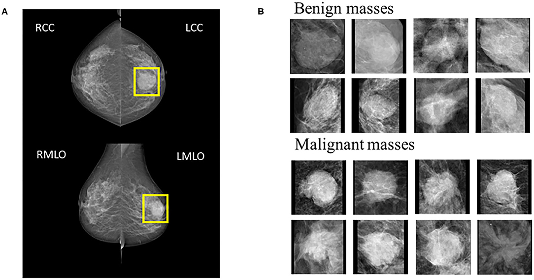 Benign Vs Malignant Cells