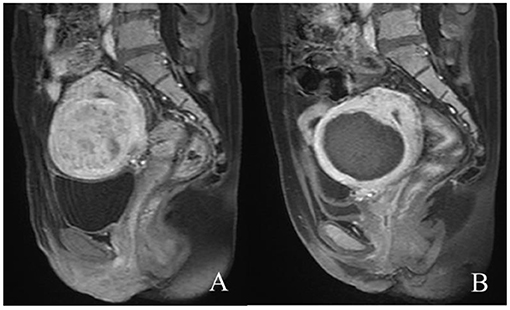 Uterine Fibroids Mri