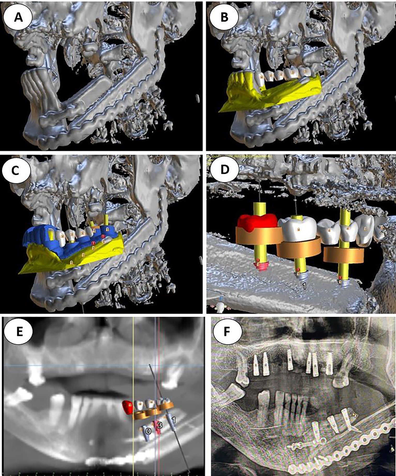 3d Art Implant