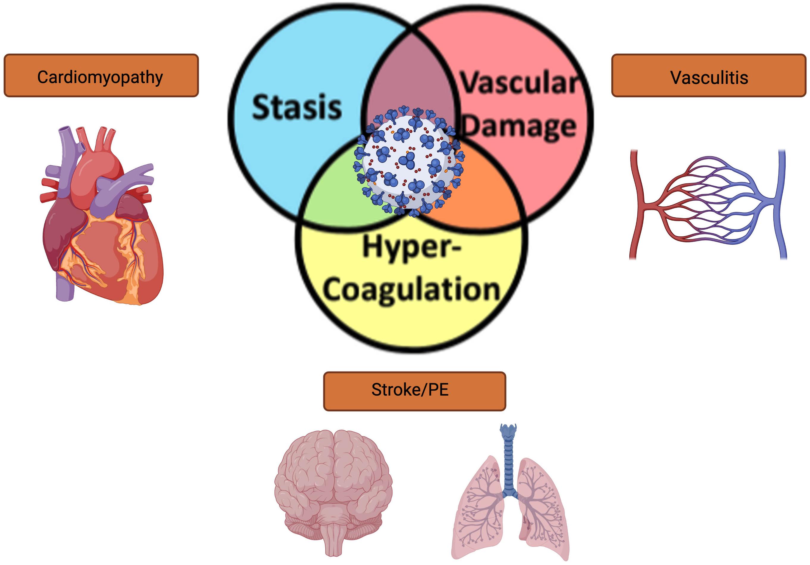 Frontiers | Virchow’s Triad and the Role of Thrombosis in COVID-Related ...