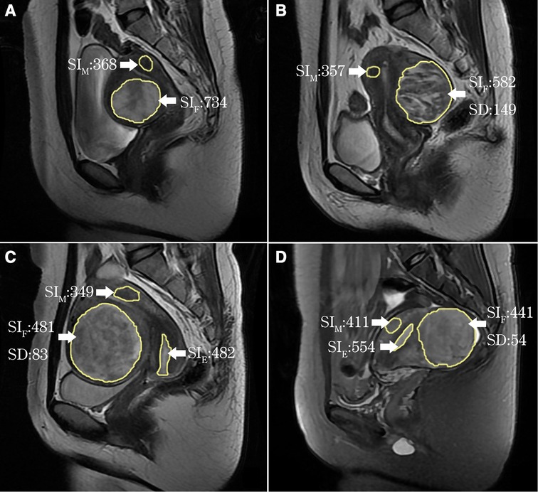 Uterine Fibroids Mri