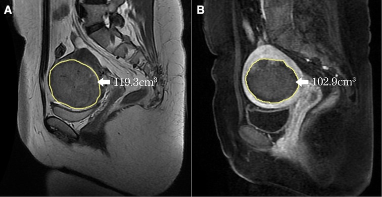 Frontiers | Ultrasound-guided HIFU for uterine fibroids of hyperintense ...