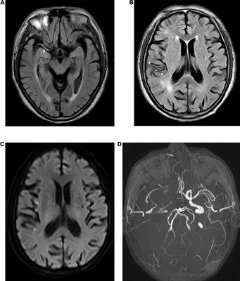 Frontiers | Fluid-Attenuated Inversion Recovery Vascular Hyperintensity ...