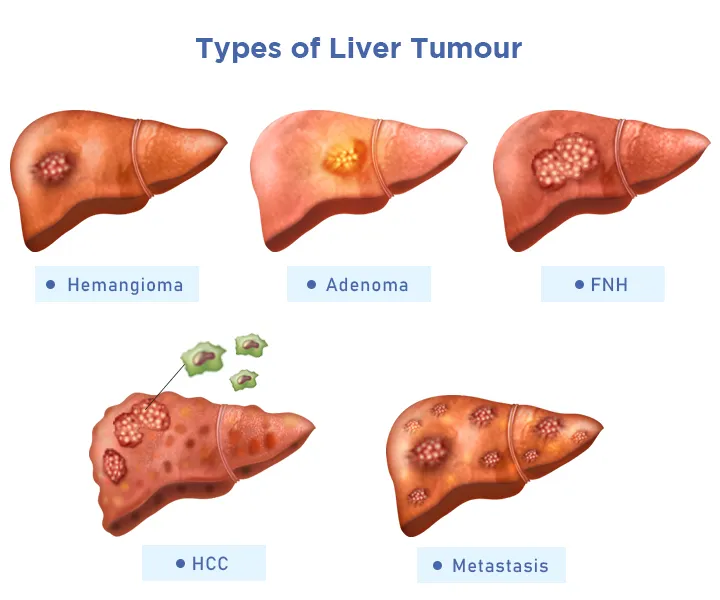 Liver Cancer: Causes, Symptoms, Diagnosis and Treatment - Dr. Harsh J Shah