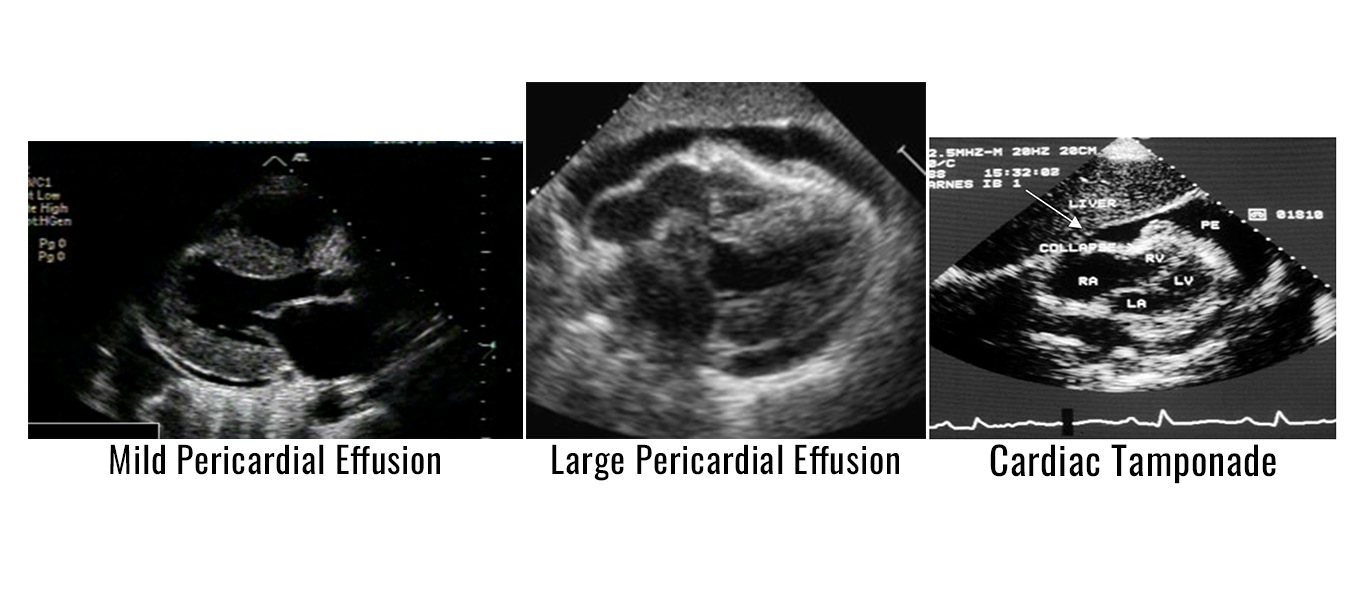 Echocardiography Assessment of Pericardial Effusion and Cardiac ...